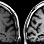 いずれも７０代の人の脳の磁気共鳴画像装置（ＭＲＩ）画像。健康な人（左）と比べ、アルツハイマー型認知症の人（右）の脳は萎縮が進み、隙間が多くなっているのが分かる（古和教授提供）